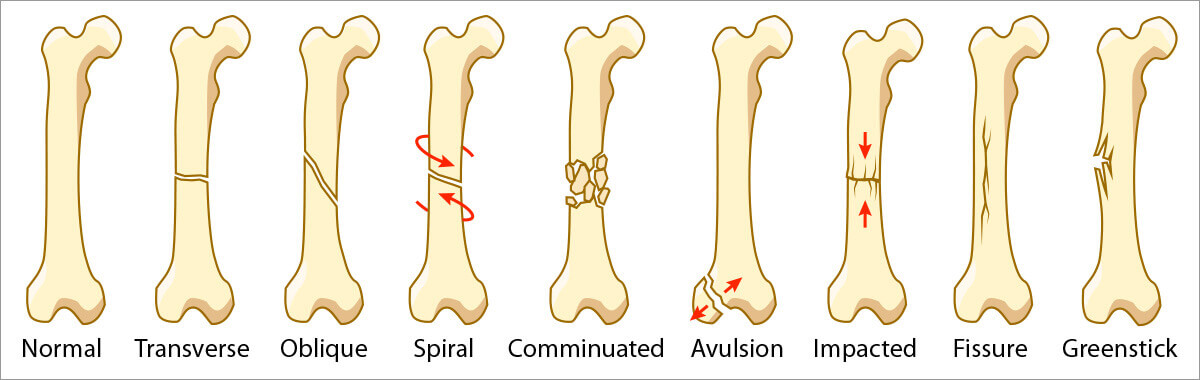 sabine-deviche-bone-fracture-types (1) (1).jpg